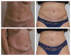 Abdominoplastika - prim. MUDr. Veliký
