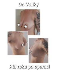 Modelace prsou - Plastická a estetická chirurgie Poděbrady - prim. MUDr. Veliký
