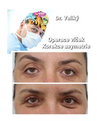 Operace očních víček - Plastická a estetická chirurgie Poděbrady - prim. MUDr. Veliký