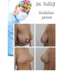 Zmenšení prsou - Plastická a estetická chirurgie Poděbrady - prim. MUDr. Veliký