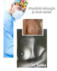 Zvětšení prsou - Plastická a estetická chirurgie Poděbrady - prim. MUDr. Veliký