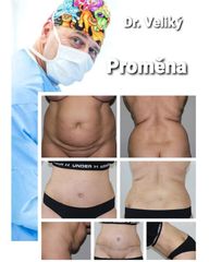 Abdominoplastika - Plastická a estetická chirurgie Poděbrady - prim. MUDr. Veliký