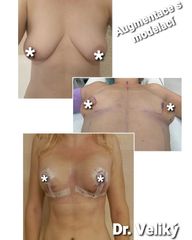 Zvětšení prsou - Plastická a estetická chirurgie Poděbrady - prim. MUDr. Veliký