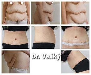 Abdominoplastika - Plastická a estetická chirurgie Poděbrady - prim. MUDr. Veliký