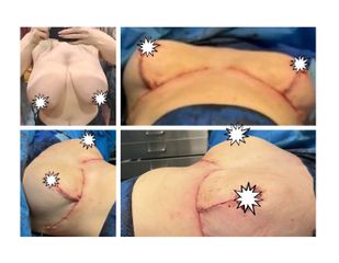 Zmenšení prsou - Plastická a estetická chirurgie Poděbrady - prim. MUDr. Veliký