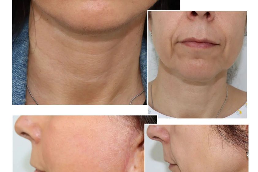 Odstranění podbradku před a po - 841574