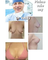Modelace prsou - Plastická a estetická chirurgie Poděbrady - prim. MUDr. Veliký