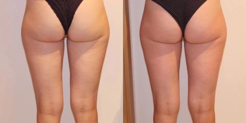 Bezbolestná liposukce a odstranění celulitidy na stehnech a hýždích, zpevnění pokožky, 1 ošetření.