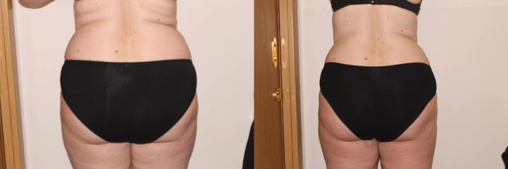 Ultrazvuková neinvazivní lipolýza, 8 ošetření, úbytek 10 cm.