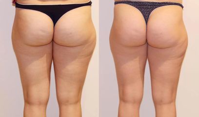 Bezbolestná liposukce a odstranění celulitidy na stehnech a hýždích, úbytek 5cm za 10 kur