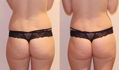 Liposukce a odstranění celulitidy na stehnech a hýždích, zpevnění pokožky 2 ošetření