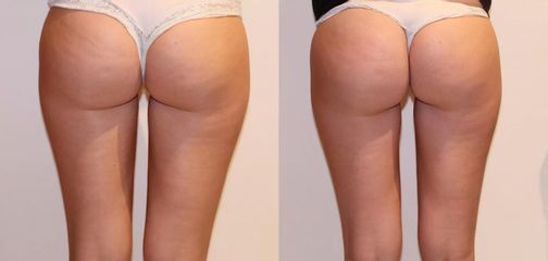 Bezbolestná liposukce a odstranění celulitidy na stehnech a hýždích, 1 ošetření