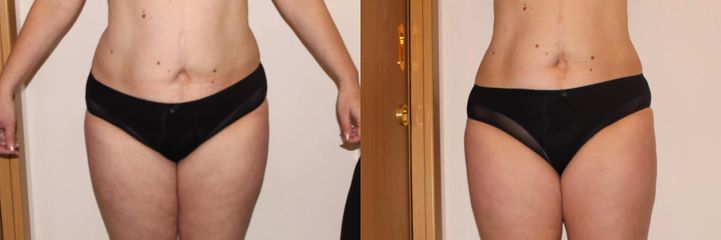 Alternativa liposukce po 8 kúrách, úbytek 10 cm.