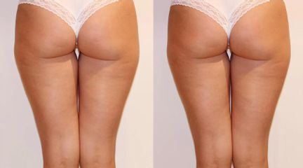 Liposukce a odstranění celulitidy na stehnech, zpevnění pokožky úbytek 2cm 1 kúra