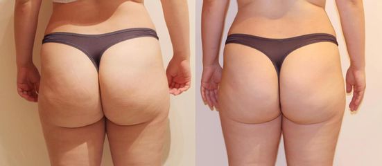 Použila jsem slim up, program na liposukci a odstranění celulitidy -5cm 10 kur