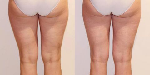 Bezbolestná liposukce a odstranění celulitidy na stehnech a hýždích, zpevnění pokožky 1 kúra.