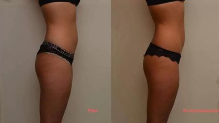 Bezbolestná liposukce boků, hýždí a stehen z profilu