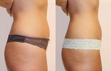 Bezbolestná liposukce břicha, stehen, úbytek 8cm za 12 kur