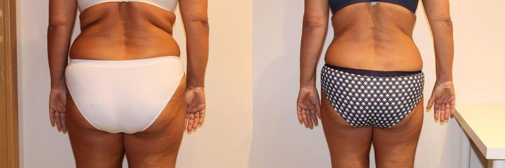 Alternativa liposukce po 12 kúrách, úbytek 10 cm.