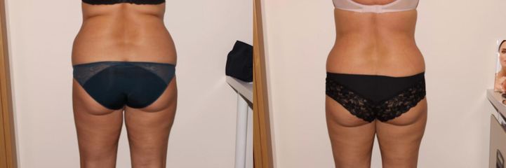 Bezbolestná liposukce, hubnutí hýždě a nohy po 12 procedúrách, úbytek 10 cm