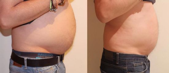 Bezbolestná lisposukce břicha úbytek 8 cm po 3 kúrách.