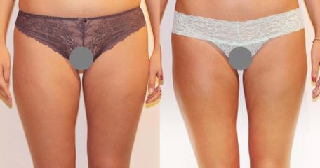 Bezbolestná liposukce a odstranění celulitidy na stehnech a hýždích, 6 kur, úbytek 6cm.