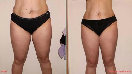 Alternativa liposukce po 8 kúrách, úbytek 10 cm.