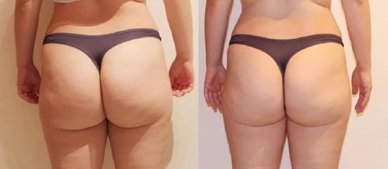 Alternativa liposukce po 6 kúrách, úbytek 6cm.