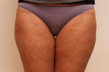 Liposukce břicha, stehen,  odstranění celulitidy po 2 kúrách