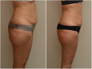 Neinvazivní liposukce - Beauty Studio Dana