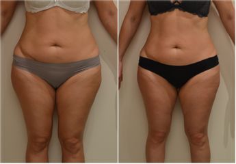 Neinvazivní liposukce - Beauty Studio Dana