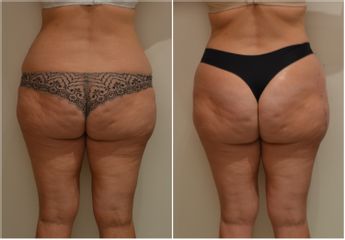 Neinvazivní liposukce - Beauty Studio Dana