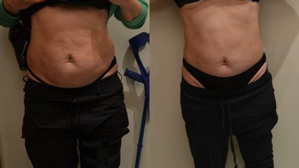 Neinvazivní liposukce - Beauty Studio Dana