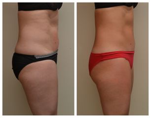Neinvazivní liposukce - Beauty Studio Dana