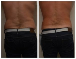 Neinvazivní liposukce - Beauty Studio Dana