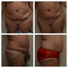 Neinvazivní liposukce - Beauty Studio Dana