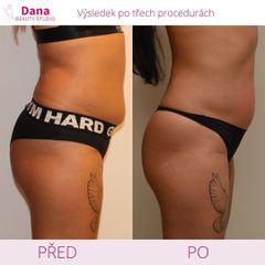 Neinvazivní liposukce - Beauty Studio Dana
