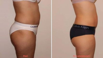 EMSculpt® - Beauty Studio Dana