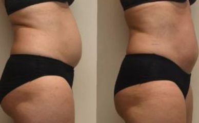 EMSculpt® - Beauty Studio Dana
