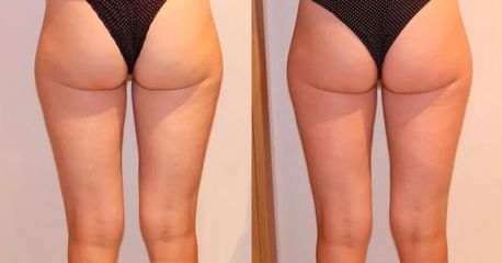 Neinvazivní liposukce - Beauty Studio Dana