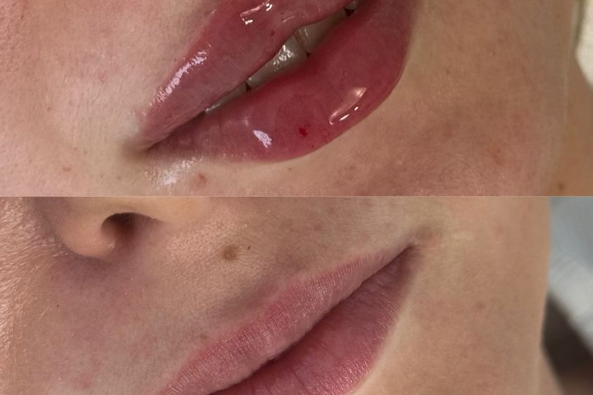 Zvětšení rtů kyselinou hyaluronovou před a po - 867557
