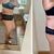 Abdominoplastika s liposukcí - MUDr. Bortlíček