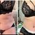 Abdominoplastika s liposukcí - MUDr. Bortlíček