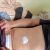 Abdominoplastika s liposukci - Mudr.Barbora Adamová