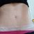 Zvětšení prsou, miniabdominoplastika a liposukce v jednom