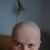 Androgenni alopecie - chtěla bych vlasy