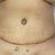 Abdominoplastika břicha pod vedením milého doktora Richarda Billicha