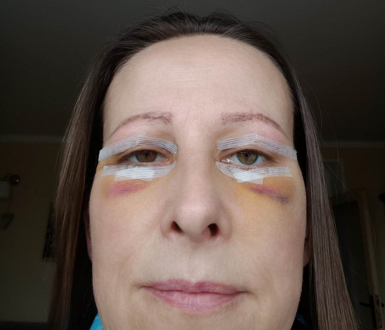 Operace očních víček - Operace očních víček - Estheticon.cz