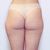 Liposukce BodyTite - MUDr. Helena Singerová, Asklepion