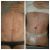 Abdominoplastika na Bulovce